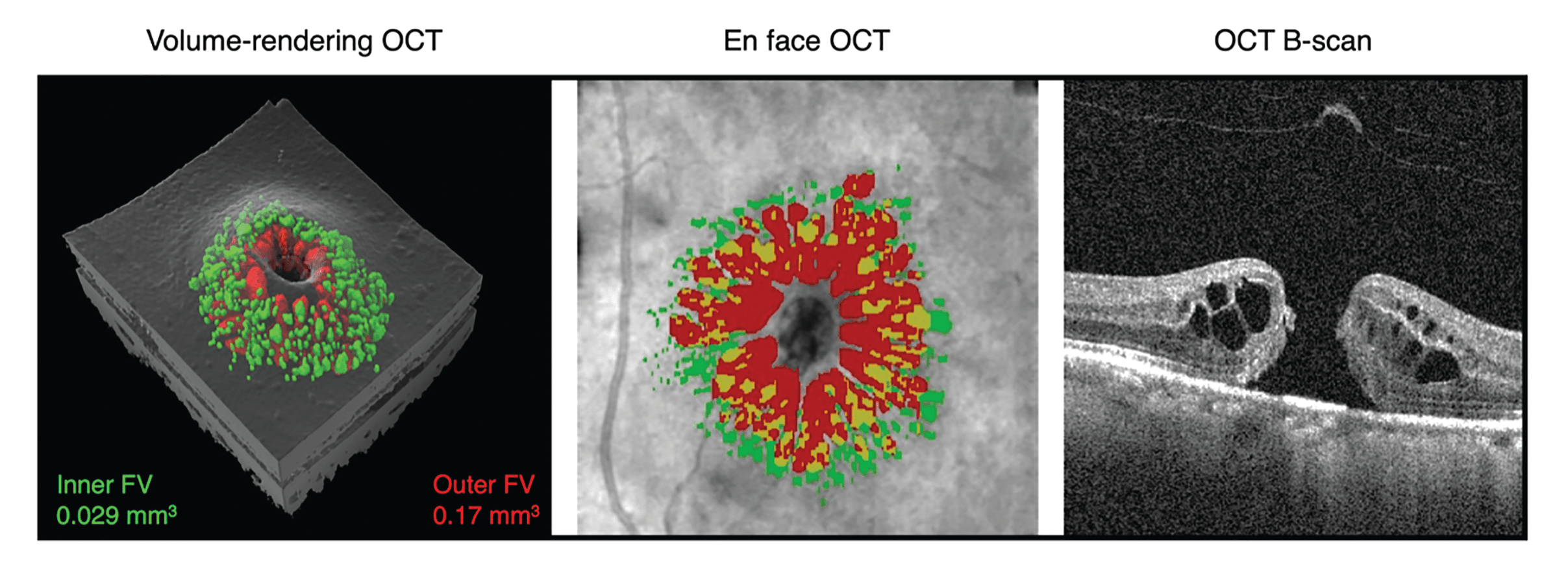 volume-rendering OCT shows outer fluid volume is greater than inner fluid value macular home repair