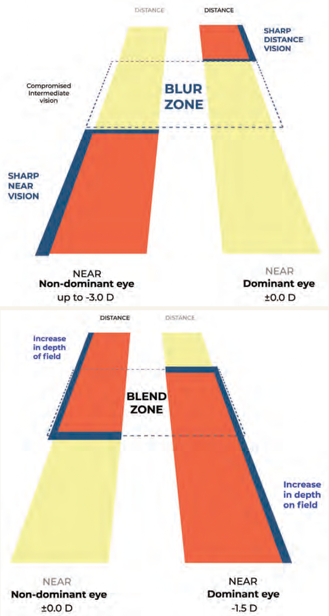 A diagram explaining the "blur zone." Blur zone in monovision causes poor intermediate vision (top) while blend zone in PRESBYOND Laser Blended Vision provides overlap in binocular vision and extends depth of field (bottom). Image courtesy of Dr van Zyl