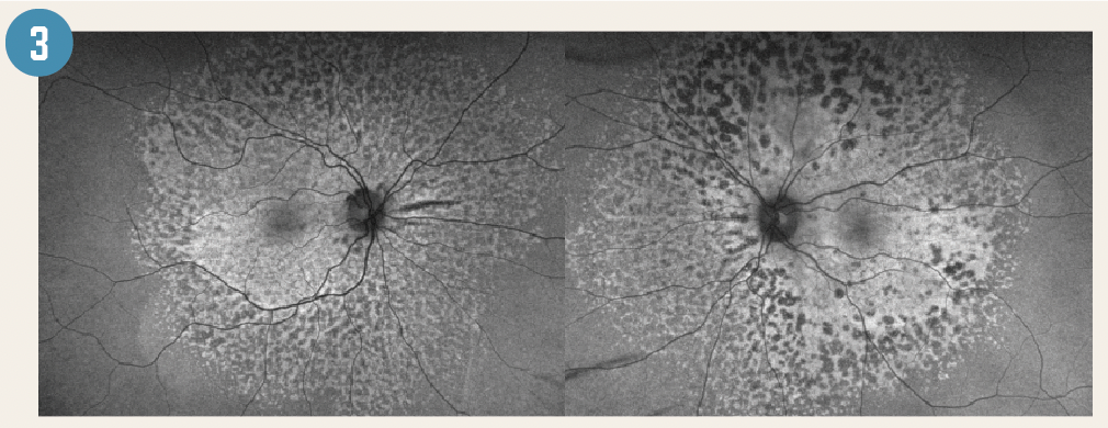 Figure 3. Fundus autofluorescence photography demonstrates diffuse area leopard pattern hypo-autofluorescence lesions that start from macula and extend to the midperipheral retina in both eyes. (Images courtesy of the authors)