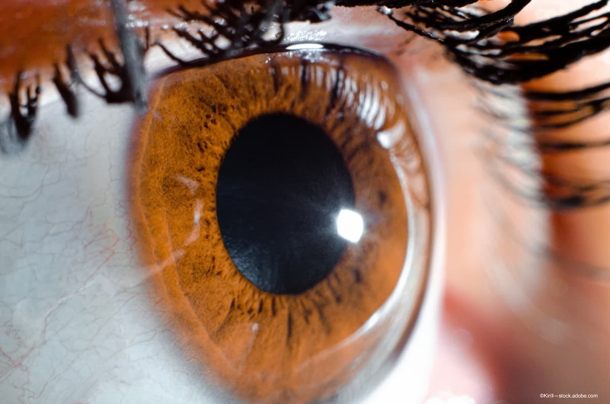 An eye towards plateau iris and its implications for patients