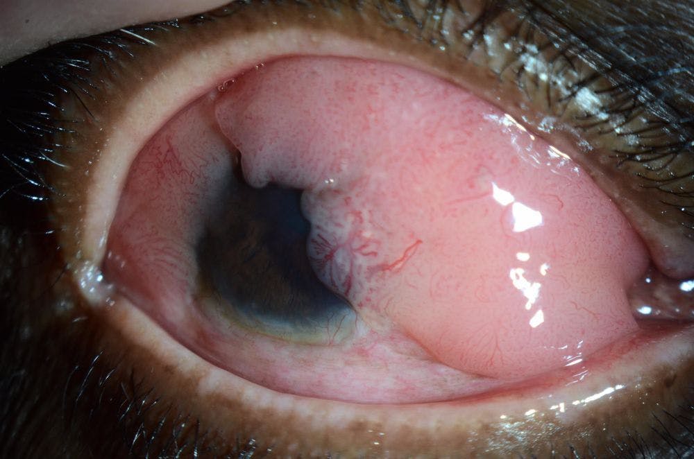 Investigators found that prevalence rates of ocular surface tumours differed across all geographic areas. (Image courtesy of Nathan Hall, MS, BS)