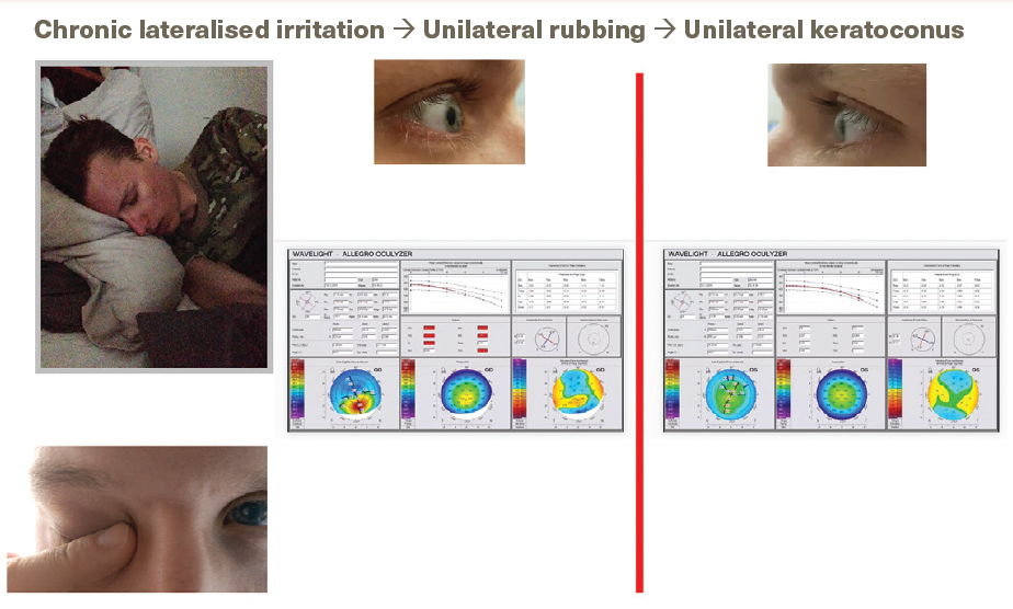 Figure 4. A very asymmetrical or even unilateral keratoconus. The picture of the sleeping position was taken by the mother of this patient whom, on the whole, only rubbed his right eye.