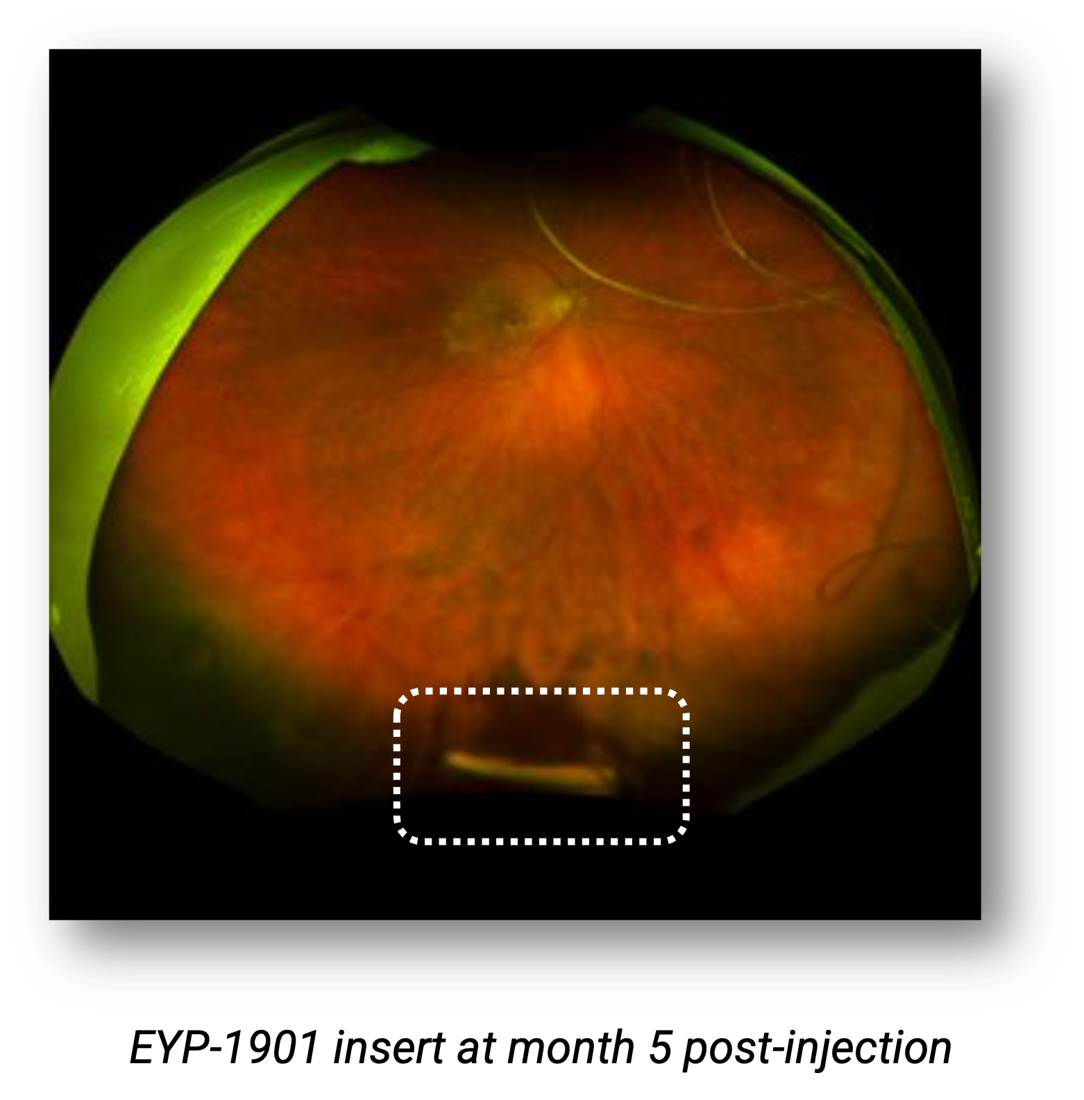 An EYP-1901 implant in the vitreous cavity of a patient from the DAVIO trial