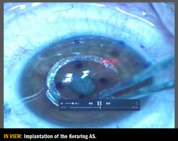 Towards a customised treatment of patients with keratoconic eyes