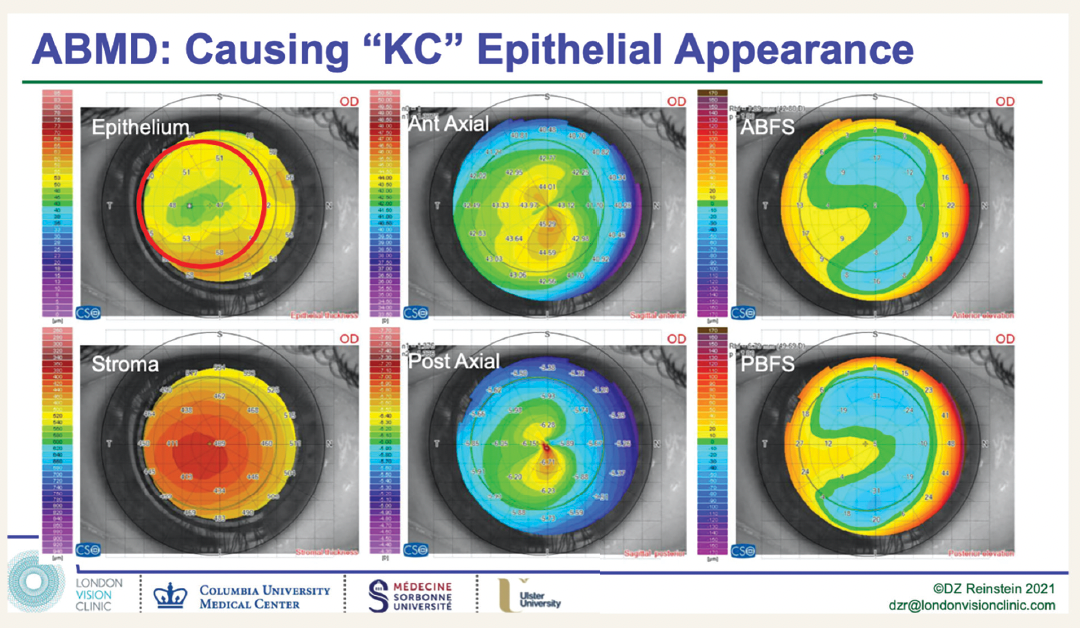 Corneal ectasia part 3: OCT epithelial thickness measurements allow monitoring of corneal changes