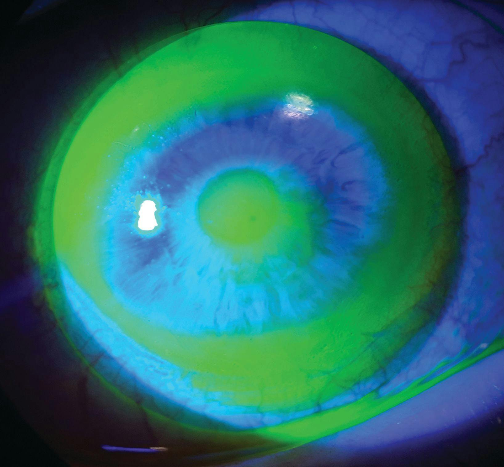 fluorogram of the scleral multifocal contact lens