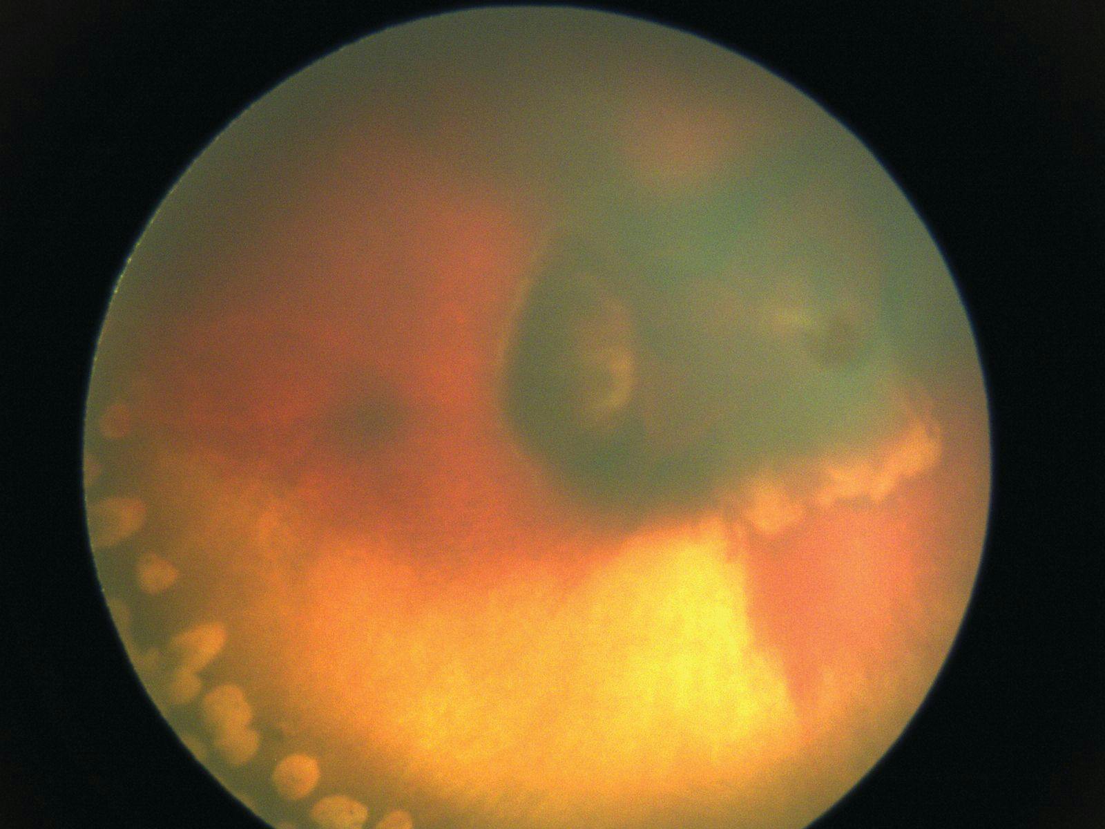Fundus photo 1 month following laser treatment for Norrie disease. (Image courtesy of Dr Janet L. Alexander)