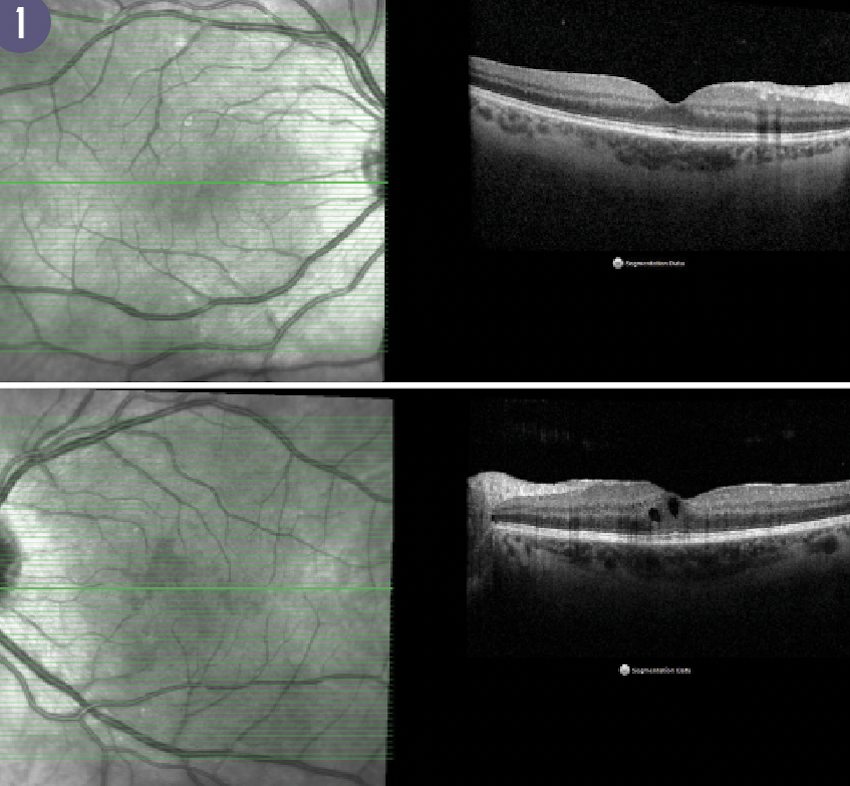Figure 1 shows optical coherence tomography of a patient with intermediate uveitis, demonstrating only mild cystic macular oedema in the left eye.
