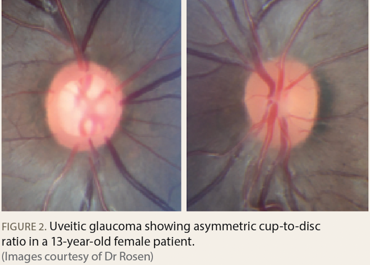Uveitic glaucoma showing asymmetric cup-to-disc ratio in a 13-year-old female patient.  (Images courtesy of Dr Rosen) 