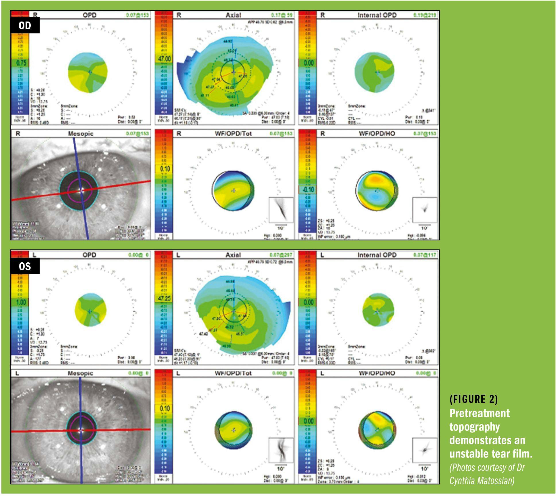 Several images of pretreatment tomography showing unstable tear film