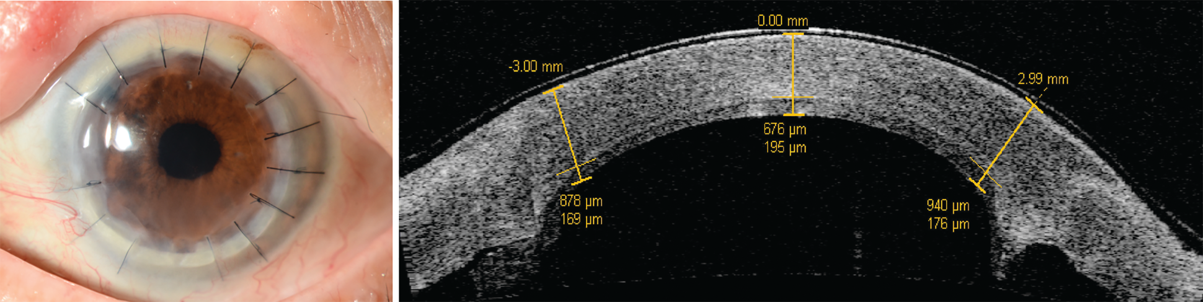 Figure 1. Slit lamp picture and anterior segment OCT image (Visante, Zeiss, Germany) of a patient that received Descemet's stripping DSAEK under a previously failed PK. 