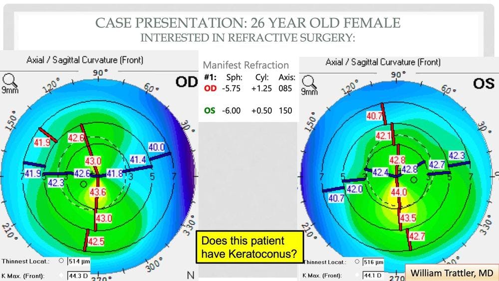 Genetic testing may be the key to identifying keratoconus suspects