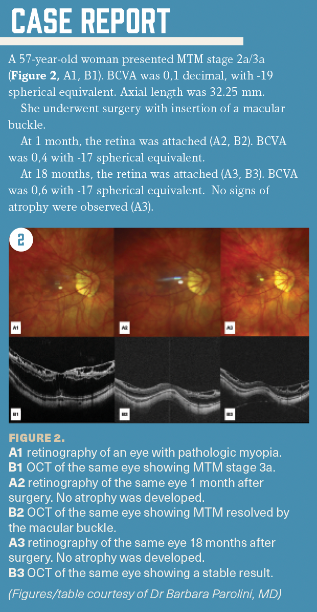 A sidebar shows the case report of a 57-year-old woman who presented myopic traction maculopathy.