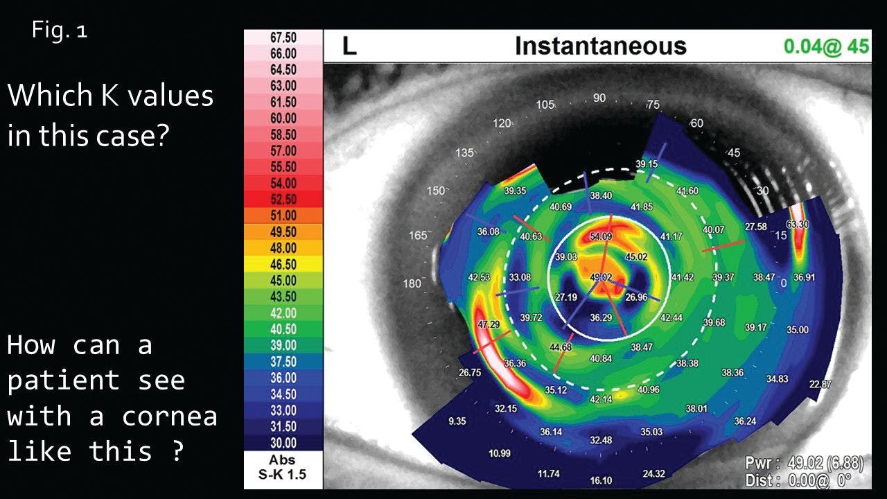 Figure 1. An aberrated cornea prevents precise biometry.