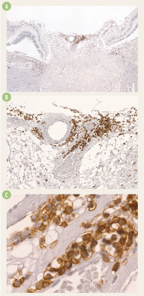 Histopath slides showing the chronic angiocentric lymphocytic infiltration at low (A), medium (B) and high (C) magnification. 