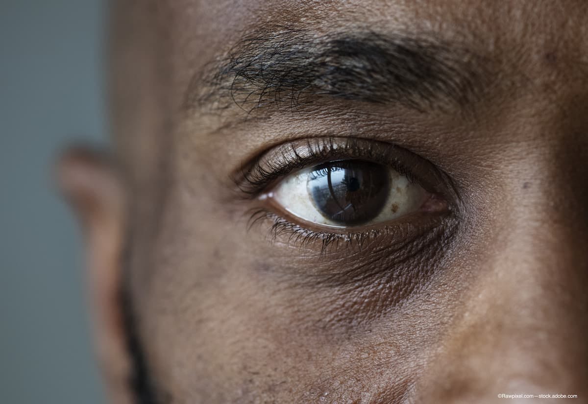 African American glaucoma study targets gene therapy options