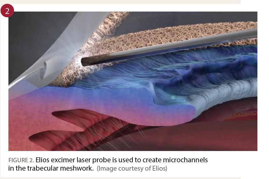 Elios excimer laser probe is used to create microchannels in the trabecular meshwork
