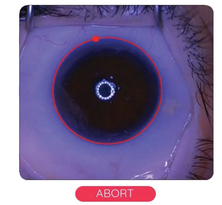 DSLT treatment screen during treatment of a post-trabeculectomy eye.  