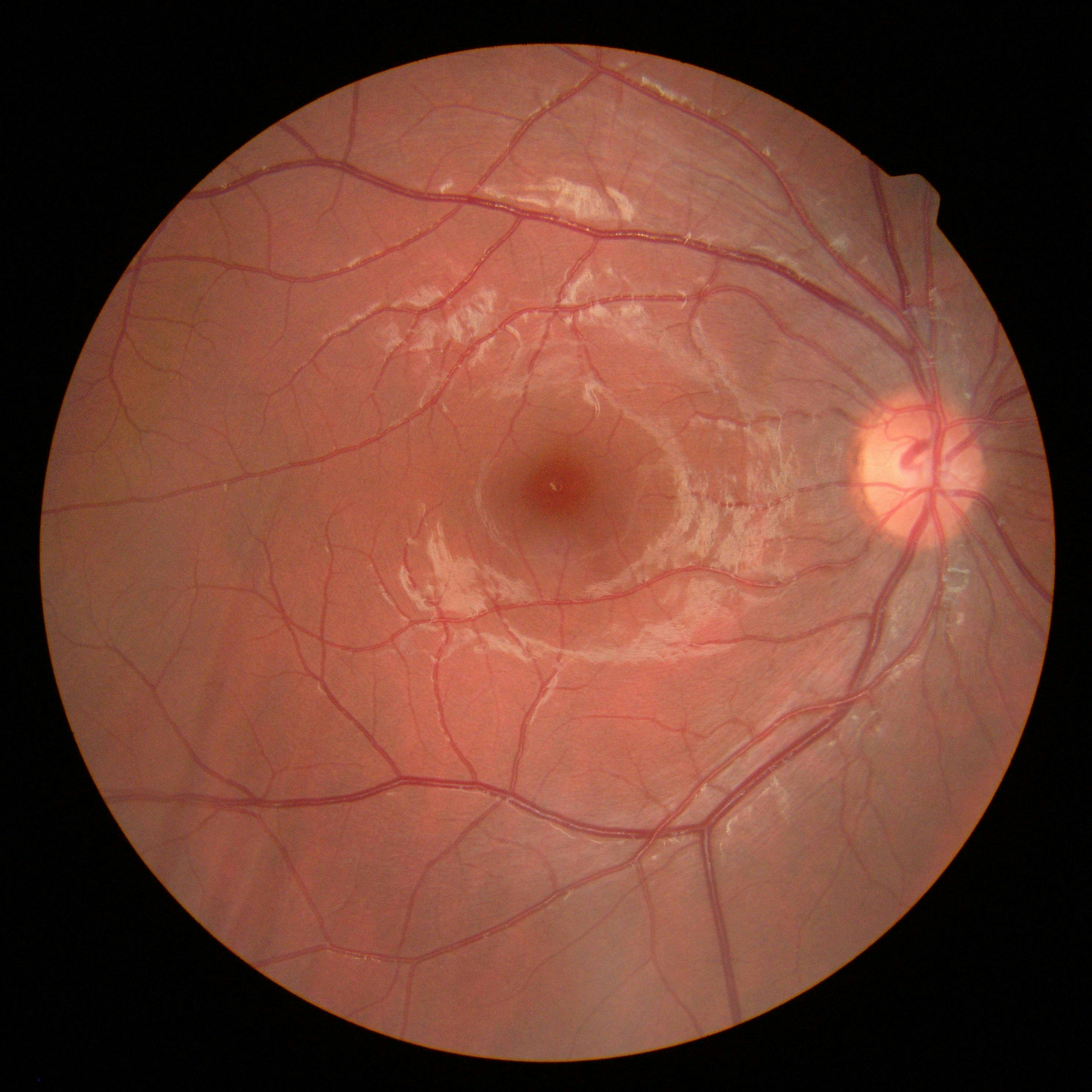 scan of eye showing macular oedema