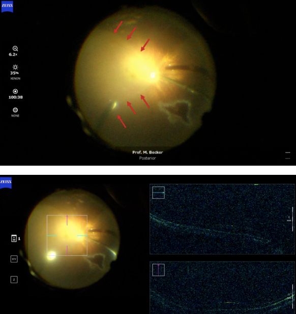 Case study: Complex retinal detachment in presumed genetic vitreoretinopathy