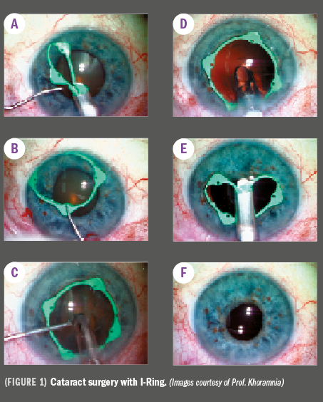 Pupil-expansion device addresses surgical challenges of small pupils