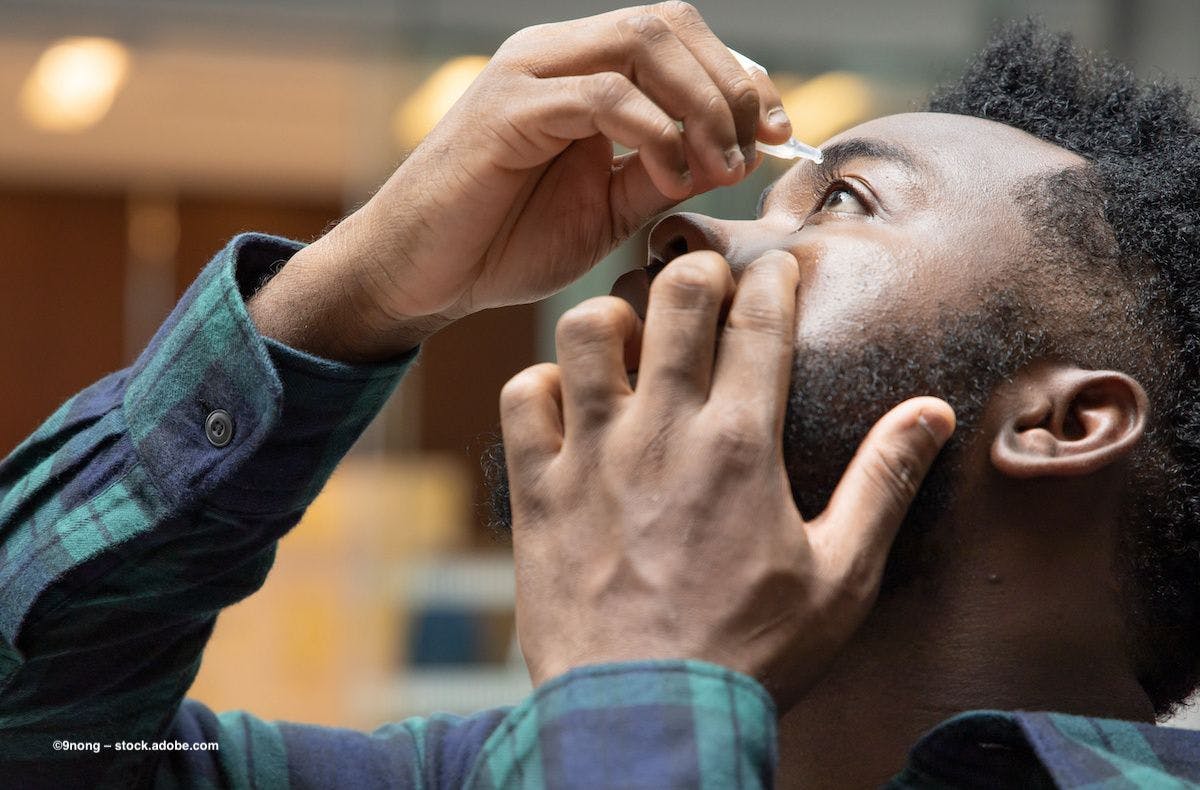 A man leans back as he administers eye drops into his eye. Image credit: ©9nong – stock.adobe.com