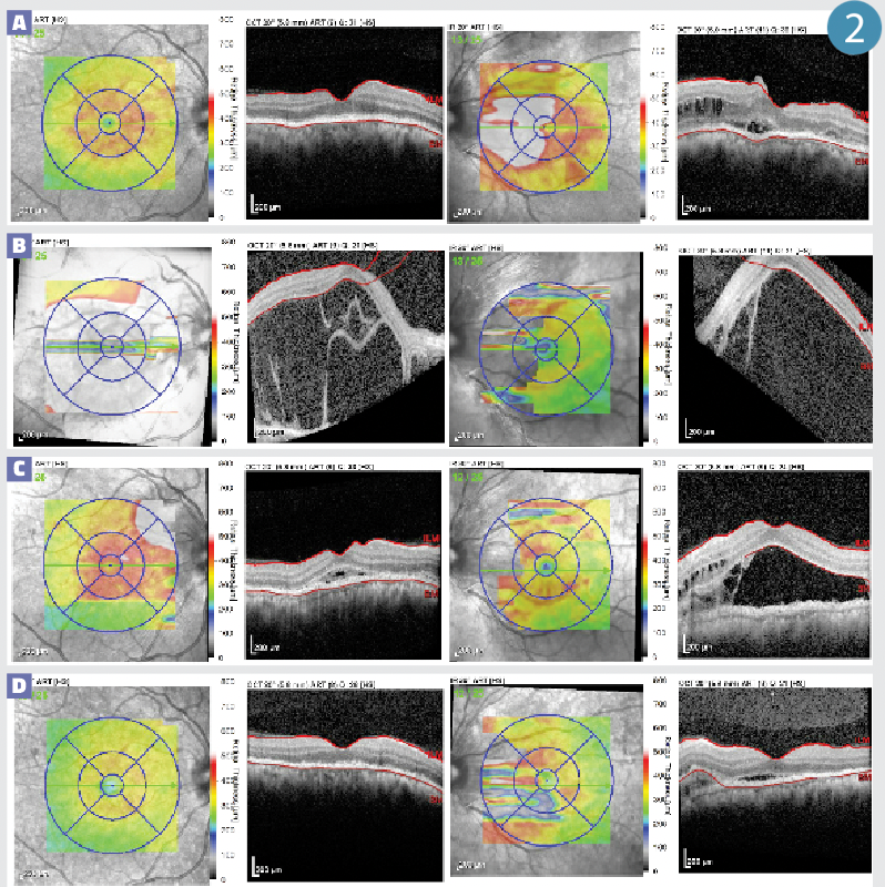 Figure 2. OCT retina of both eyes. (a) Subretinal and intraretinal fluid in the left eye on initial presentation. (b) Rapid progression of subretinal fluid with involvement of both eyes. (c) Significant improvement in the subretinal fluid after 3 cycles of plasmapheresis. (d) Complete resolution of subretinal fluid in the right eye with residual fluid in the left eye.