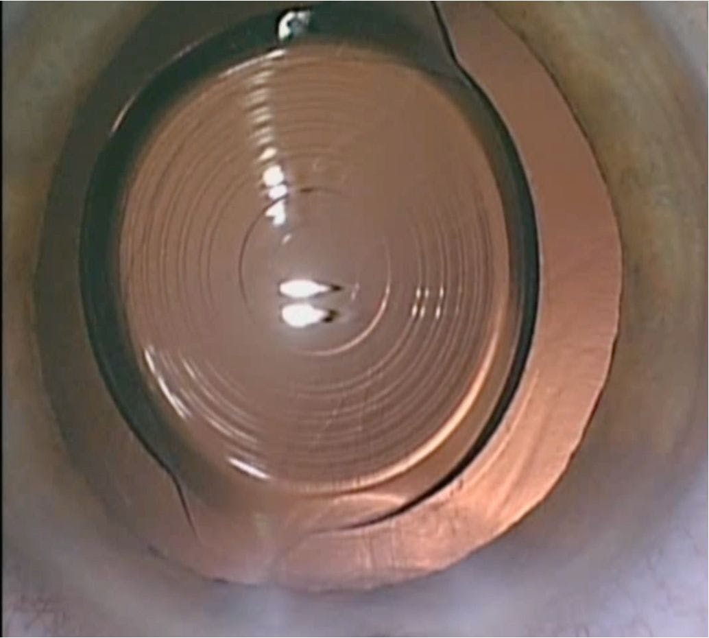 Figure 1: A Synergy IOL implanted in the eye. (Image courtesy of Dr Filomena Ribeiro)