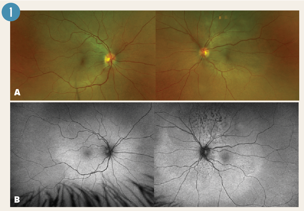Figure 1. (a) Fundus photos on initial presentation with area of subretinal fluid involving the entire macula with extension superior past the vascular arcade in the left eye. (b) Fundus autofluorescence photography demonstrates leopard pattern patches of hypo-autofluorescence superior and inferior to the left optic nerve.