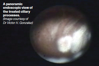 A panoramic endoscopic view of the treated ciliary processes.