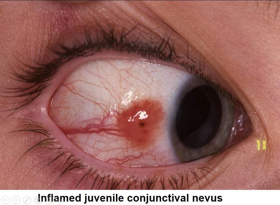 Discerning among clinical aetiologies of paediatric conjunctival tumours 