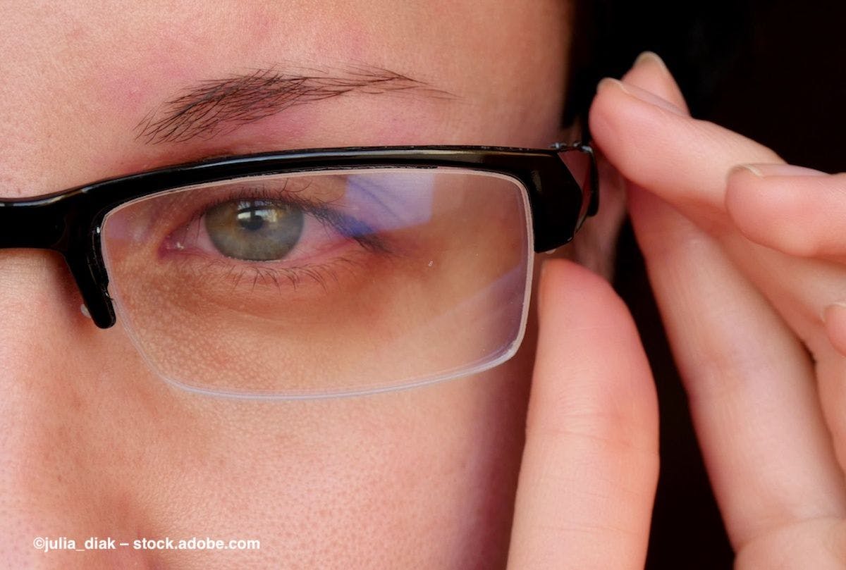 A person puts glasses on over their red, inflamed eye. Image credit: ©julia_diak – stock.adobe.com