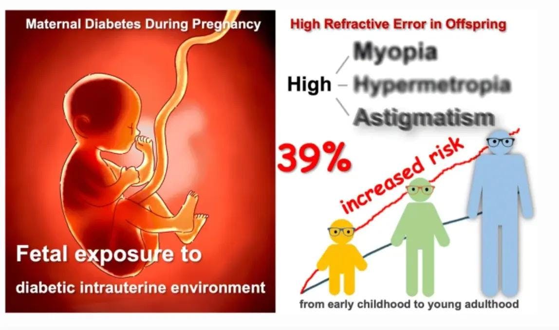 Maternal diabetes during pregnancy linked to high refractive error in offspring