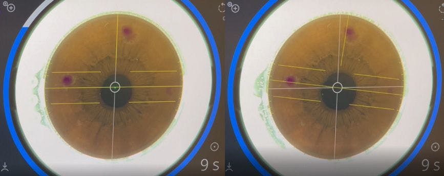Figure 3. Oculign® pattern rotation depicting cyclotorsional misalignment between the overlay reticles and three corneal markings (left), followed by perfect alignment (right).
