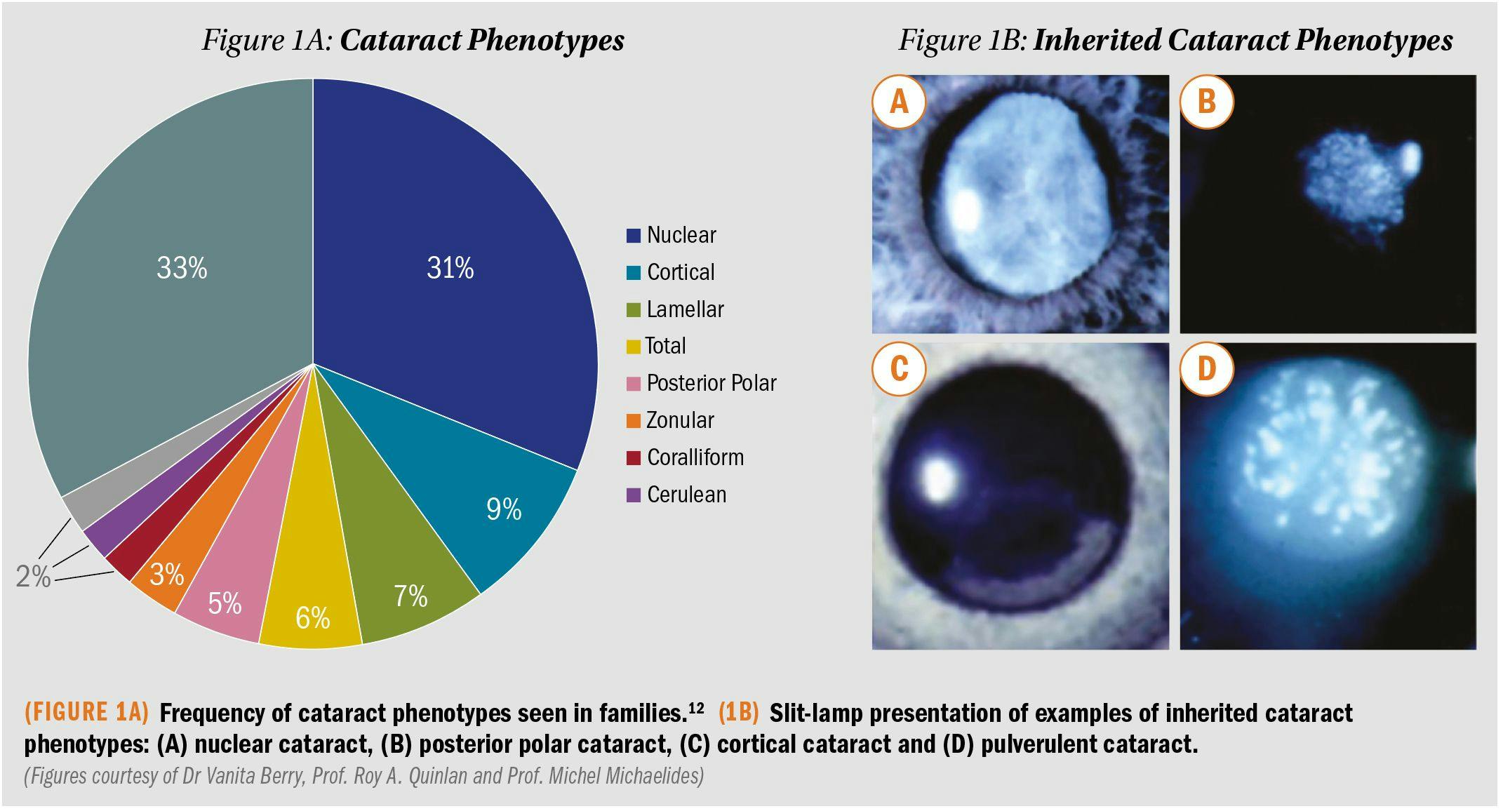 Graph showing cataract phenotypes and photos showing inherited cataract phenotypes