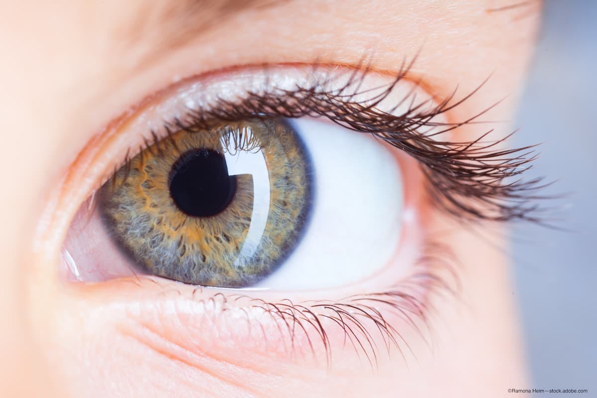 Mitomycin C associated with increase in corneal haze after corneal crosslinking