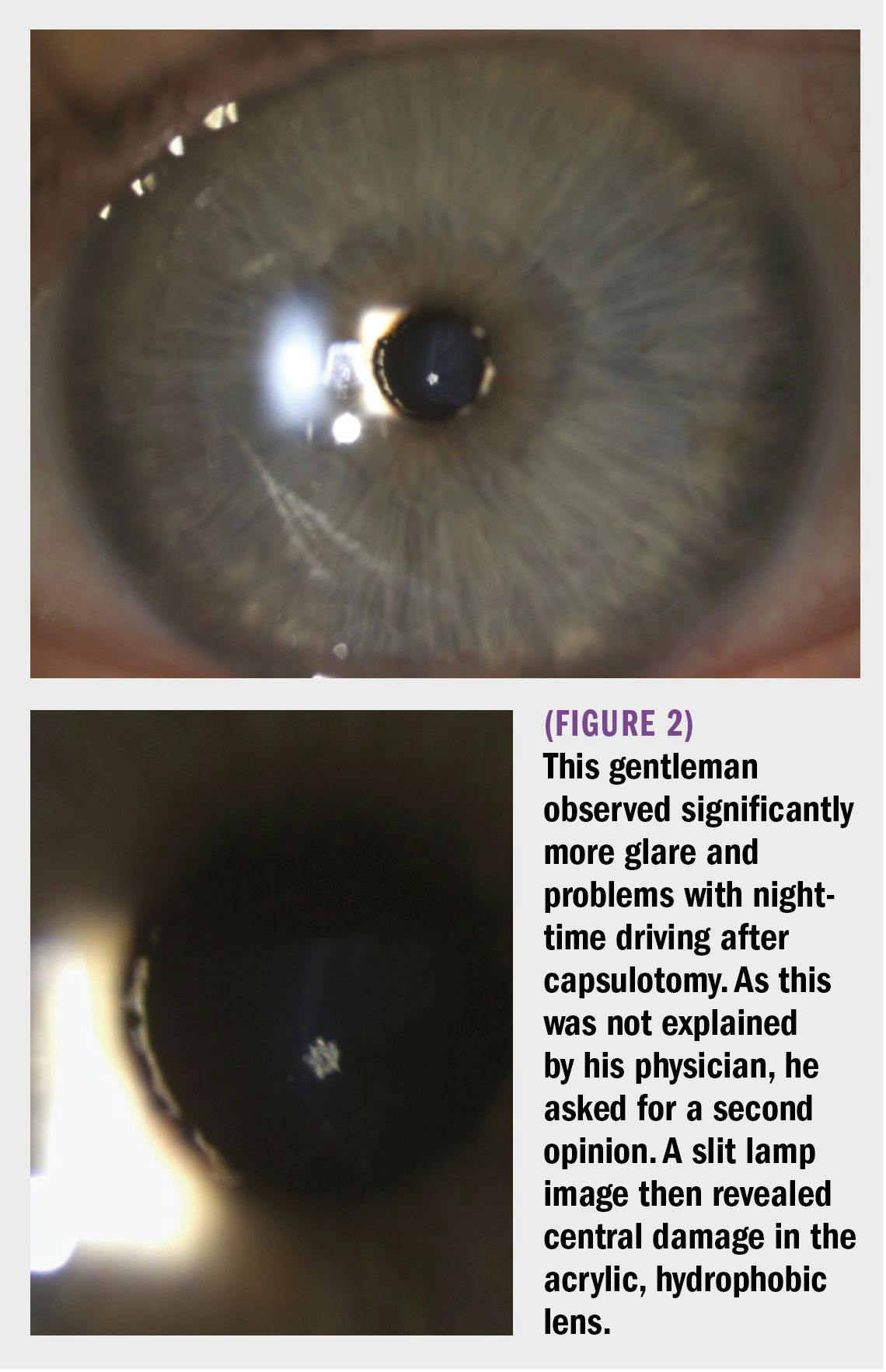 central damage in eye lens shown by slit lamp