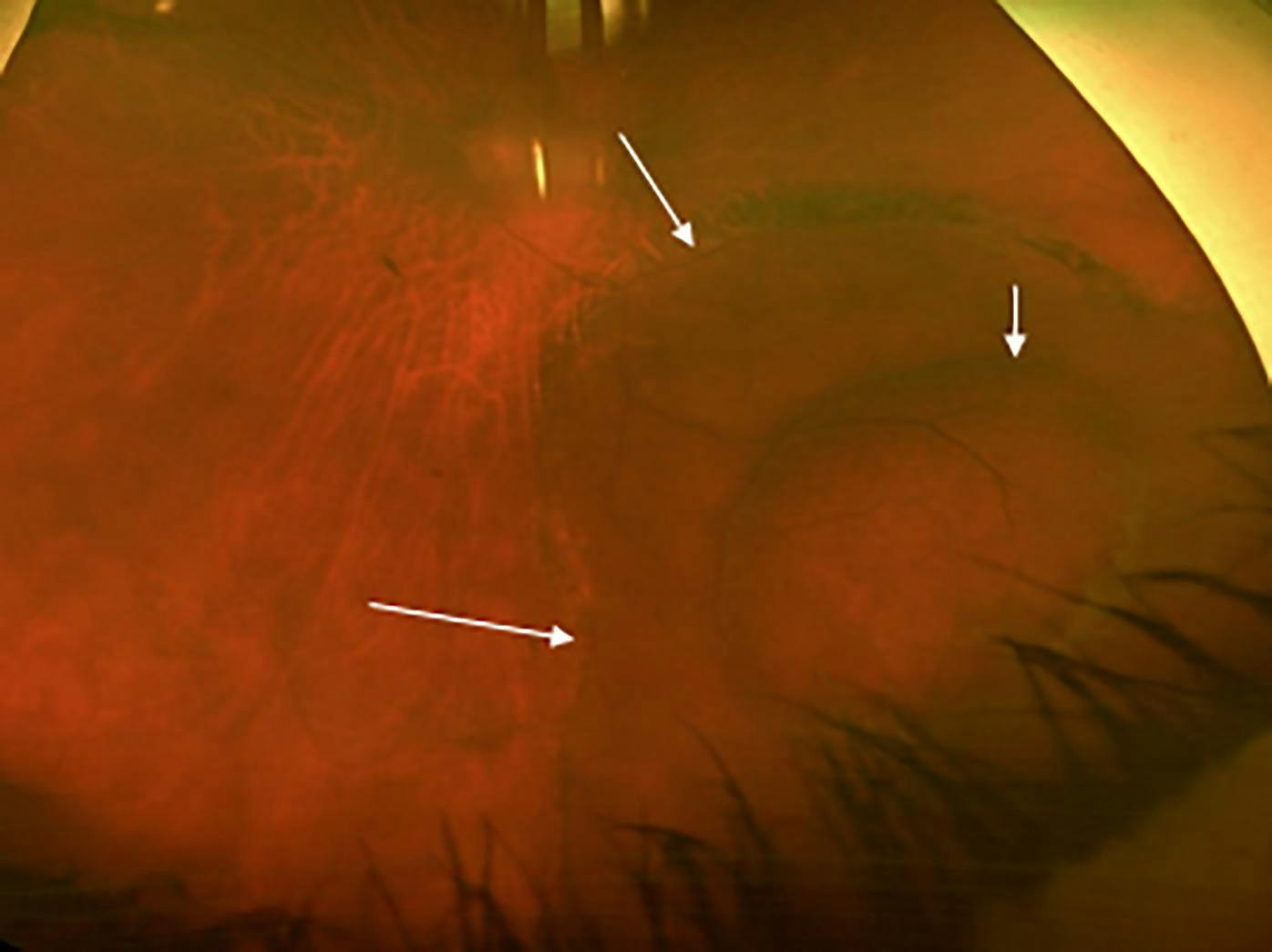 Investigating surgical approaches for progressive retinal detachments secondary to retinoschisis