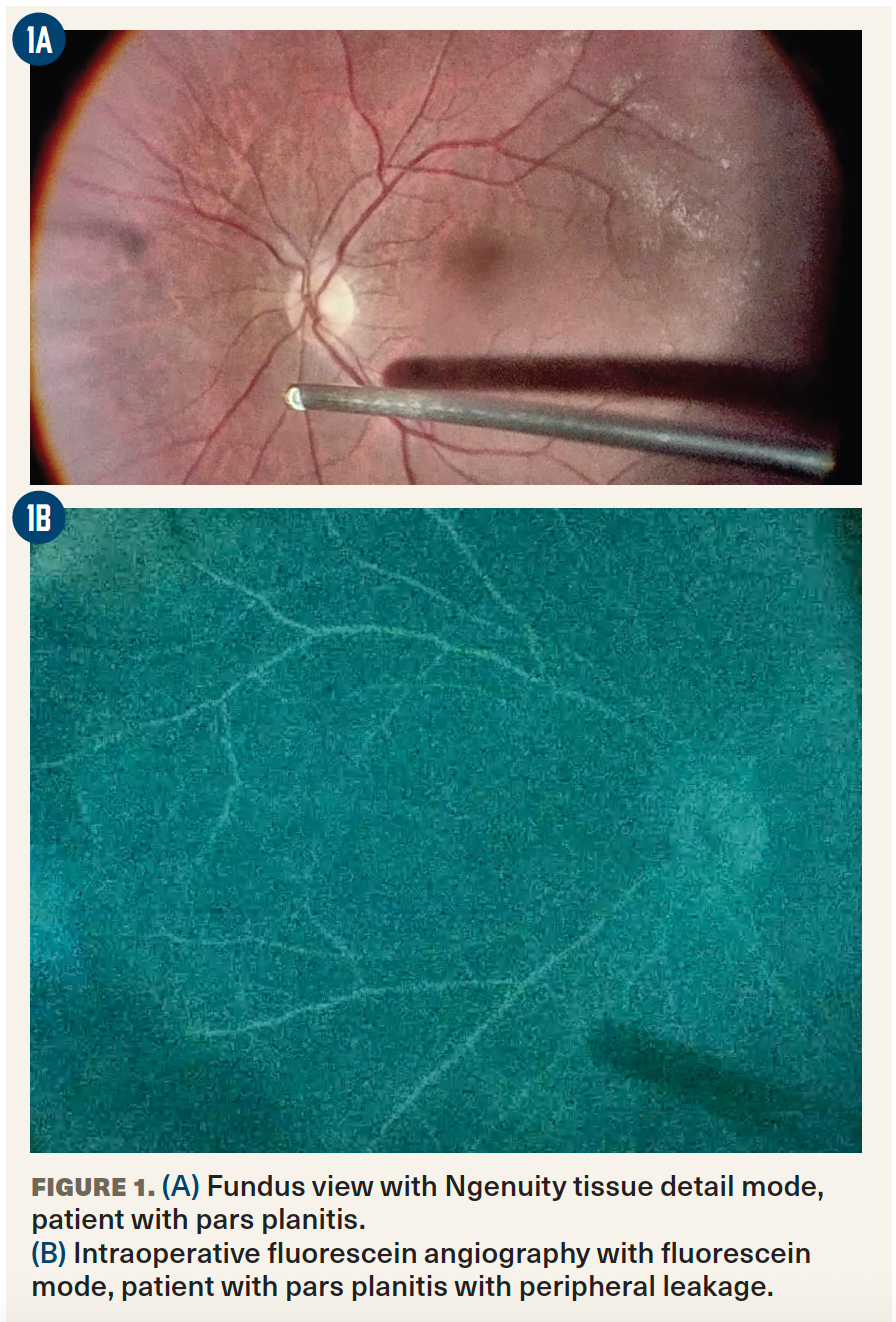 Figure 1. (A) Fundus view with Ngenuity tissue detail mode, patient with pars planitis.  (B) Intraoperative fluorescein angiography with fluorescein mode, patient with pars planitis with peripheral leakage. 