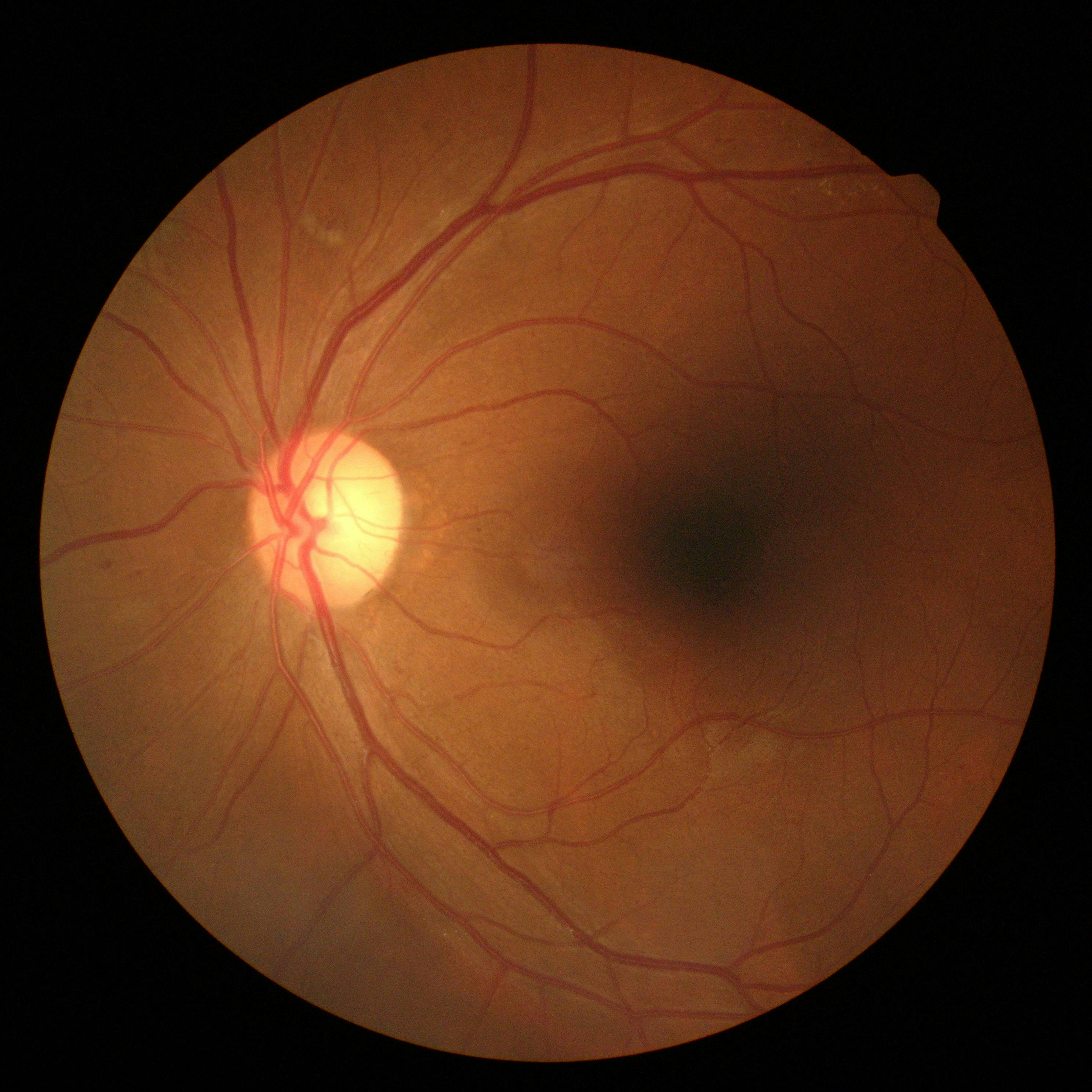 scan of eye showing diabetic macular oedema