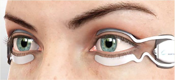 Figure. SmartLid devices applied to the eyelids (Photo courtesy of Dr Jeffrey Gemi).