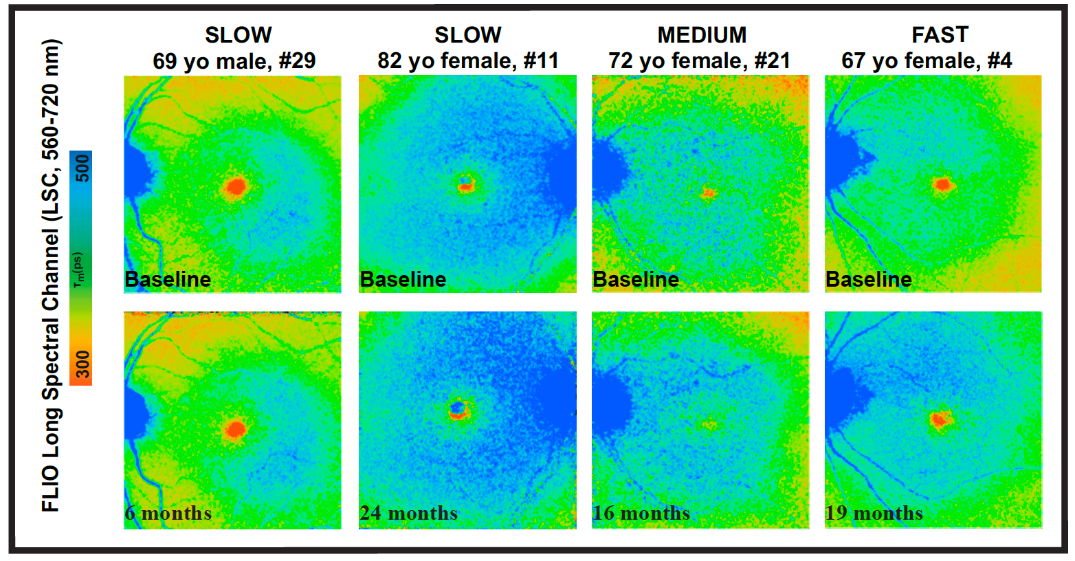 Fluorescence lifetime imaging ophthalmoscopy (FLIO) lifetimes (long spectral channel [LSC]) from 4 patients with age-related macular degeneration at baseline and follow-up. Individual patients show different progression independent of age. Progression was classified as fast, medium or slow. The follow-up time in months is indicated in the images. (Images courtesy of Jace Buxton)