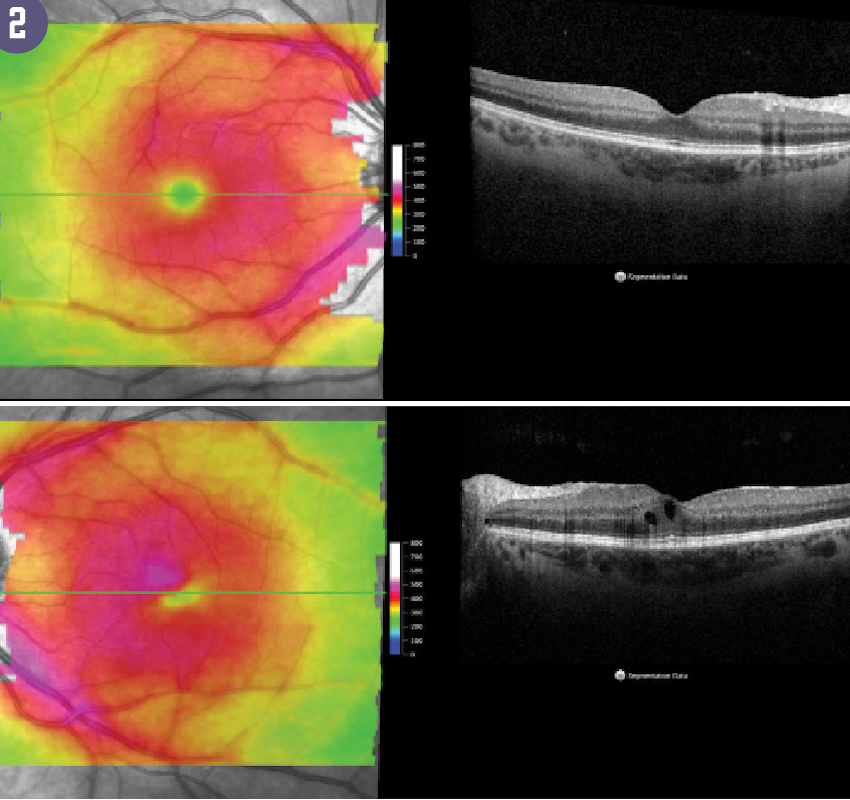 Figure 2 shows retinal thickness maps of the same patient reveal diffuse retinal thickening, not easily appreciated in Figure 1.