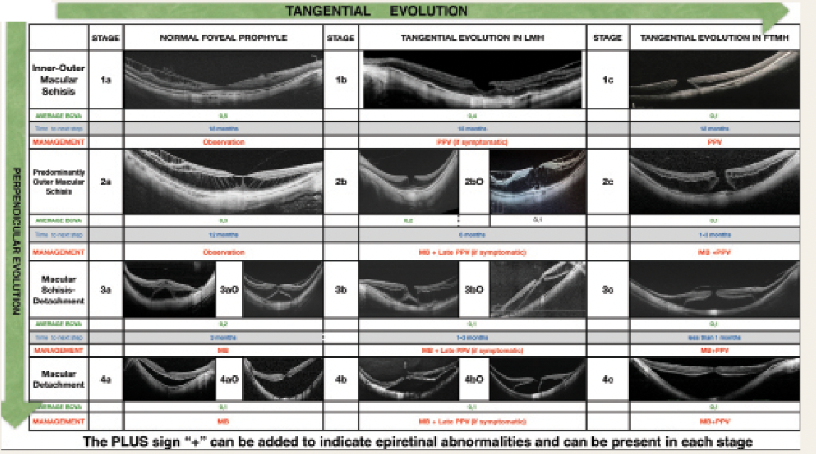 A table, labeled "Figure 1," shows pathogenesis of myopic traction maculopathy (MTM) expressed in the MTM staging system.