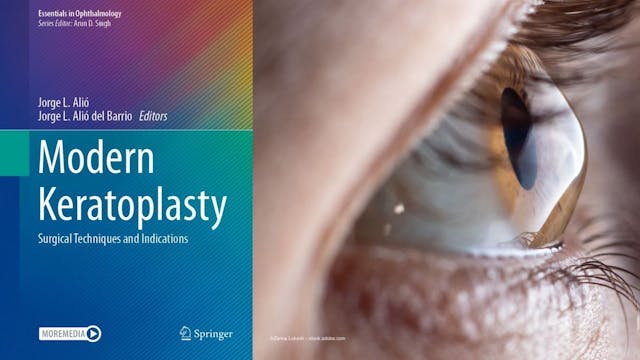 The cover of "Modern Keratoplasty: Surgical Techniques and Indications" next to an image of an eye. Book cover image used with permission from Springer Nature. Cornea image credit: ©Zarina Lukash – stock.adobe.com