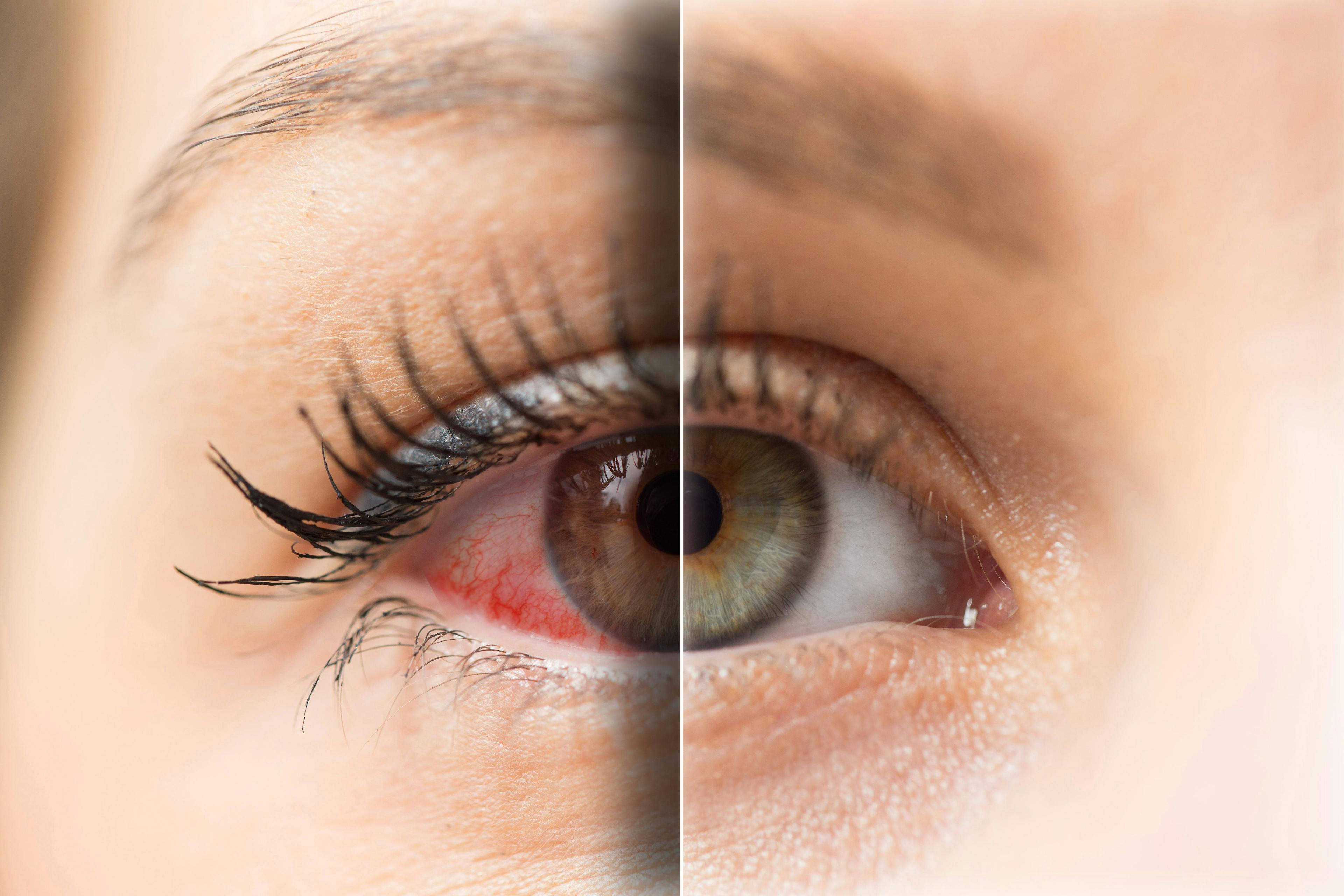 photo of woman's inflamed eye compared to her clear eye