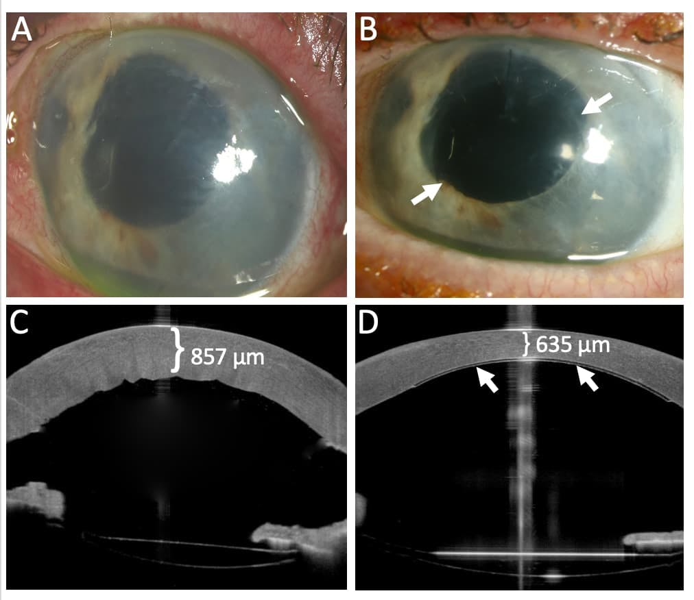 Figure 2: Slit-lamp pictures and OCT images before (A+C) and 12 weeks after implantation (B+D). Significant corneal oedema is shown in A and quantified via OCT in C. Marked resolution of corneal oedema 12 weeks after implantation is shown in B. Significant reduction in corneal thickness is measured by means of OCT in D. The white arrows show the outlines of the implant on the posterior surface of the cornea in B and D. (Images courtesy of IVCRC Heidelberg)