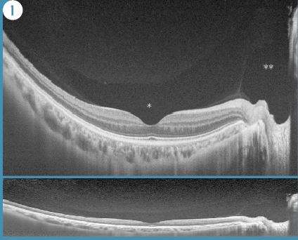 Figure 1. OCT image of 39-year-old woman shows premacular lacuna and Cloquet’s canal. Top: Premacular lacuna (*) and connected Cloquet’s (**) canal can be clearly detected. Bottom: The same case of top image with vertical and horizontal scales on a 1:1 scale.