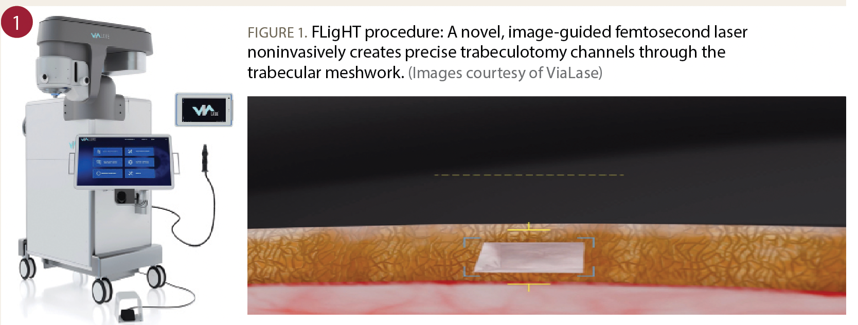 A novel, image-guided femtosecond laser  noninvasively creates precise trabeculotomy channels through the trabecular meshwork