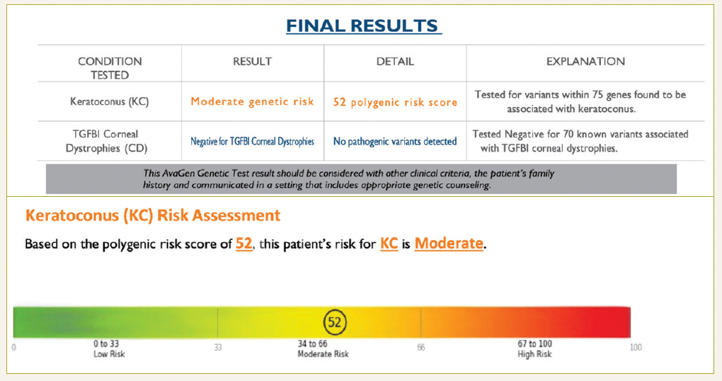 Figure 2b. Results from 31-year-old patient. Genetic testing for keratoconus facilitates earlier recognition of condition